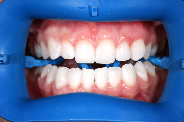 улыбка после отбеливания zoom 4 улыбка после отбеливания zoom 4